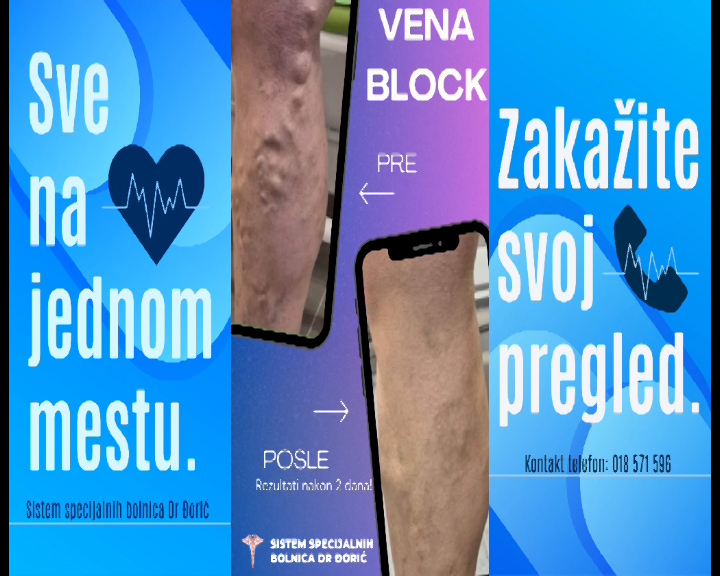 OPERACIJE PROŠIRENIH VENA VENABLOCK-om! 